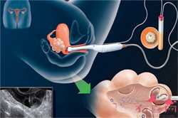 南阳代孕机构X1：子宫内膜息肉影响第三代试管婴